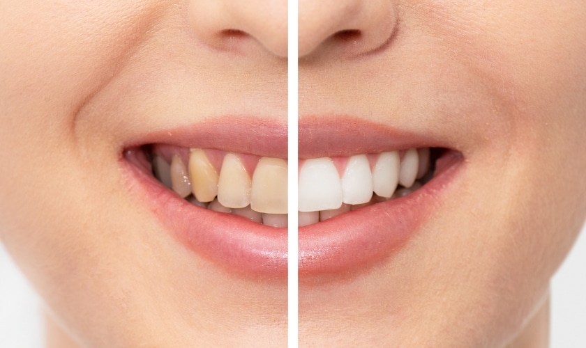 which vitamin deficiency causes yellow teeth