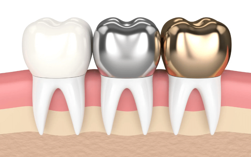 Signs For Dental Crown
