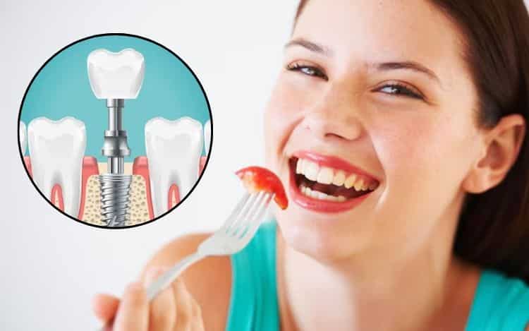 eating after dental implant healing